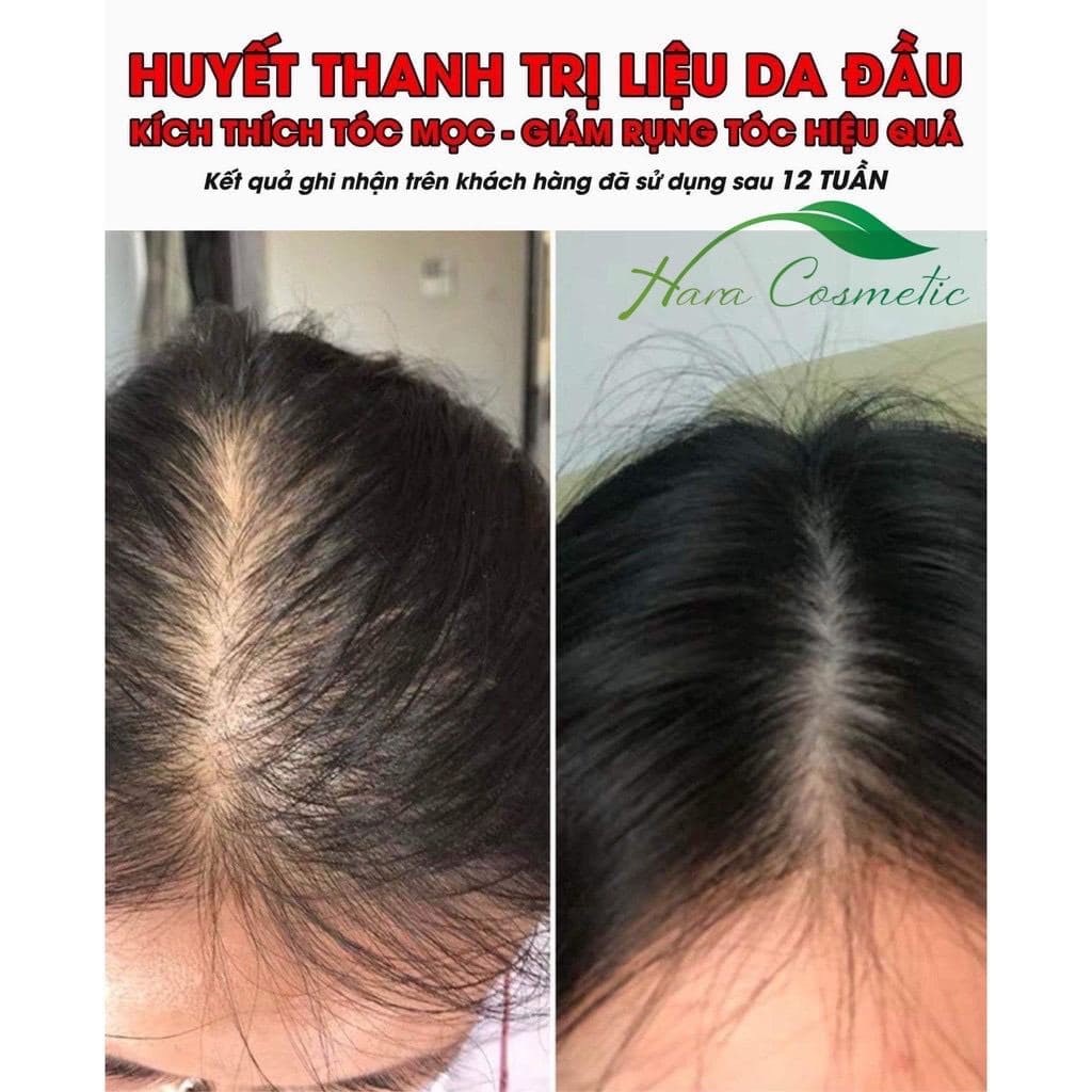 Huyết Thanh Kích Mọc Tóc Nuôi Dưỡng Nang Tóc | BigBuy360 - bigbuy360.vn