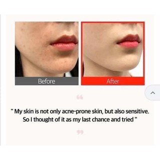 Serum chiết xuất tràm trà đỏ Some By Mi Red Teatree CicassosideFinal Solution Serum