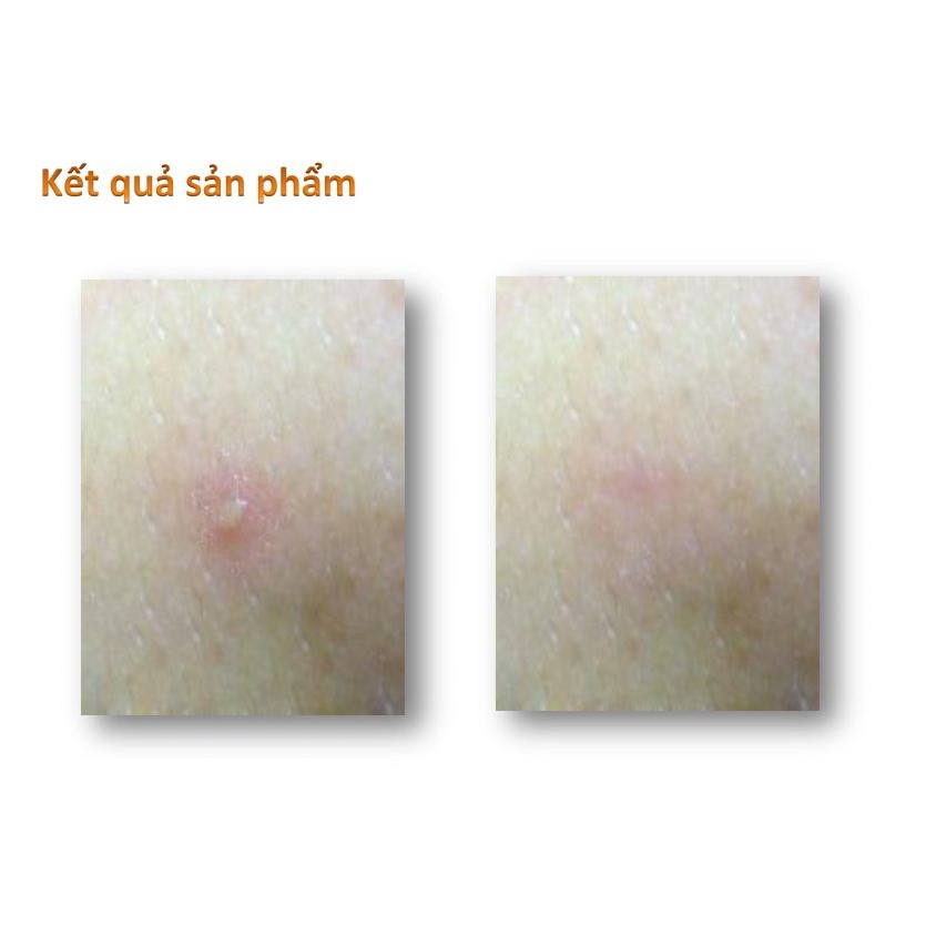 Miếng dán mụn hydrocolloid Somaderm Spot Pimple Patch 24 miếng 3 kích cỡ - MẪU MỚI HỘP XANH