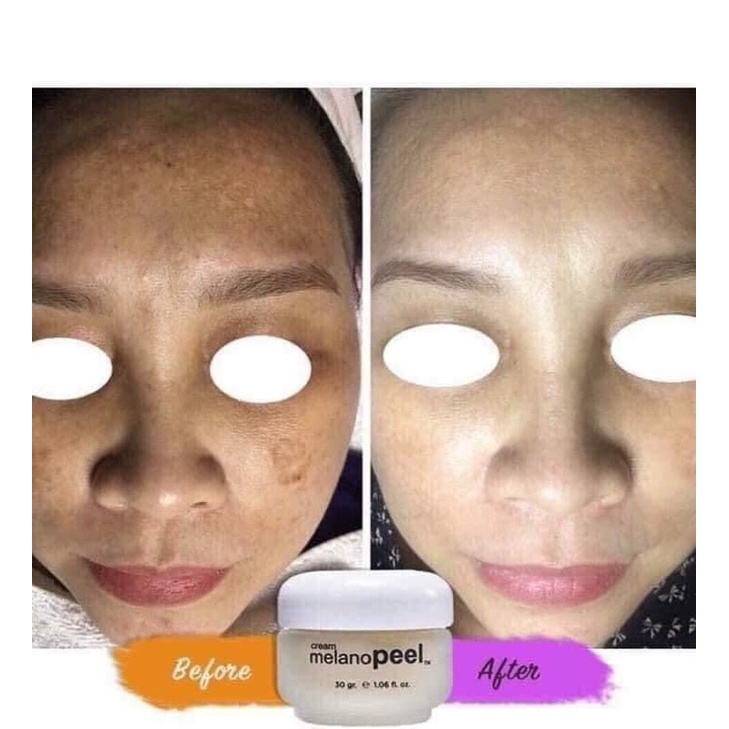 Kem lột nám Melano peel cream cao cấp | BigBuy360 - bigbuy360.vn