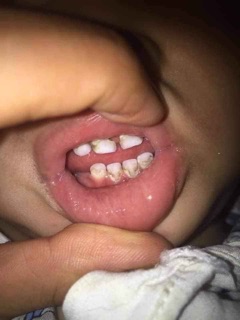 Thảo dược về răng miệng Lợi An