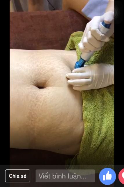 MÁY TIÊM GIẢM BÉO KO KIM THESHERA