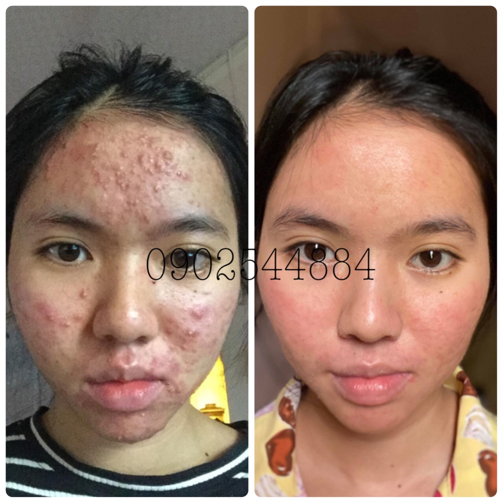 Serum mụn Hoàng Trinh