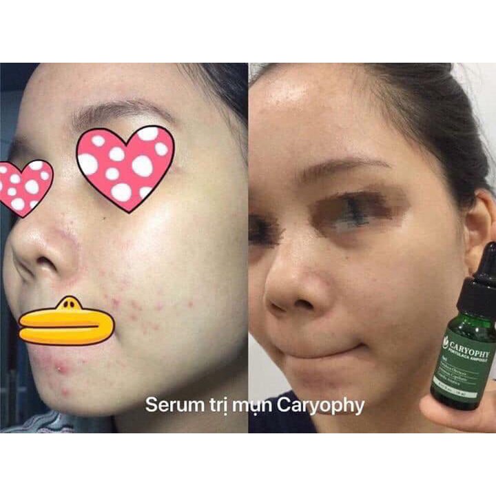Combo làm sạch da, ngăn ngừa mụn và thâm Caryophy (Sữa rửa mặt 150ml + Serum 10ml) | BigBuy360 - bigbuy360.vn