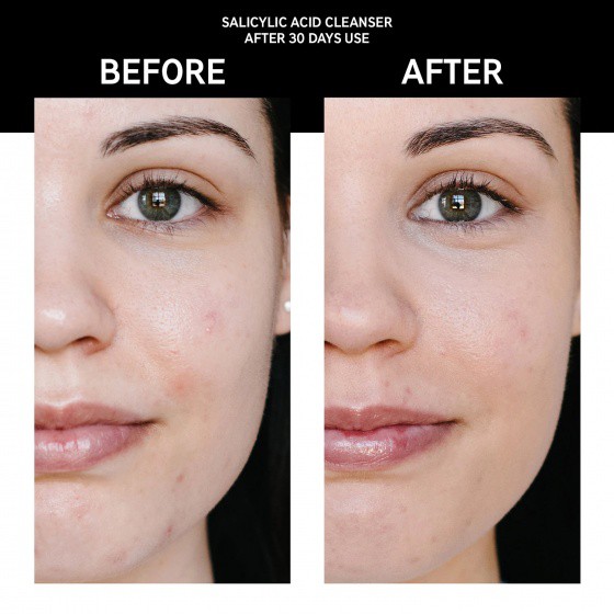 Sữa rửa mặt BHA giảm mụn kềm dầu The INKEY List Salicylic Acid Cleanser 150ml (Bill US)