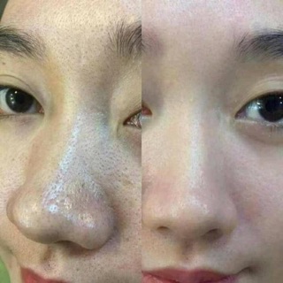 Serum ủ mụn Ohio Hàn quốc