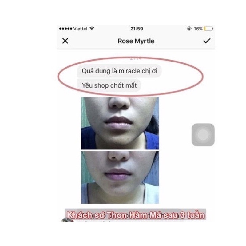 Tinh chất thu xương hàm má Miracle, hiệu quả chỉ sau 14 ngày