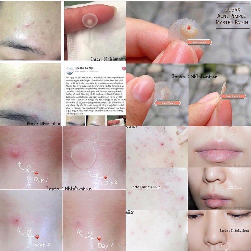 Miếng dán hút mụn Cosrx Acne Pimple Master Patch Cosrx