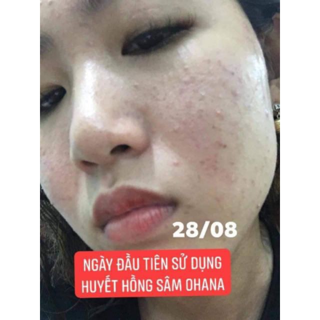 Serum Giảm Mụn Thâm Sẹo Rỗ Huyết Hồng Sâm 10ml Cam Kết Không Sưng Không Đỏ Hiệu Quả Ngay Lọ Đầu Tiên