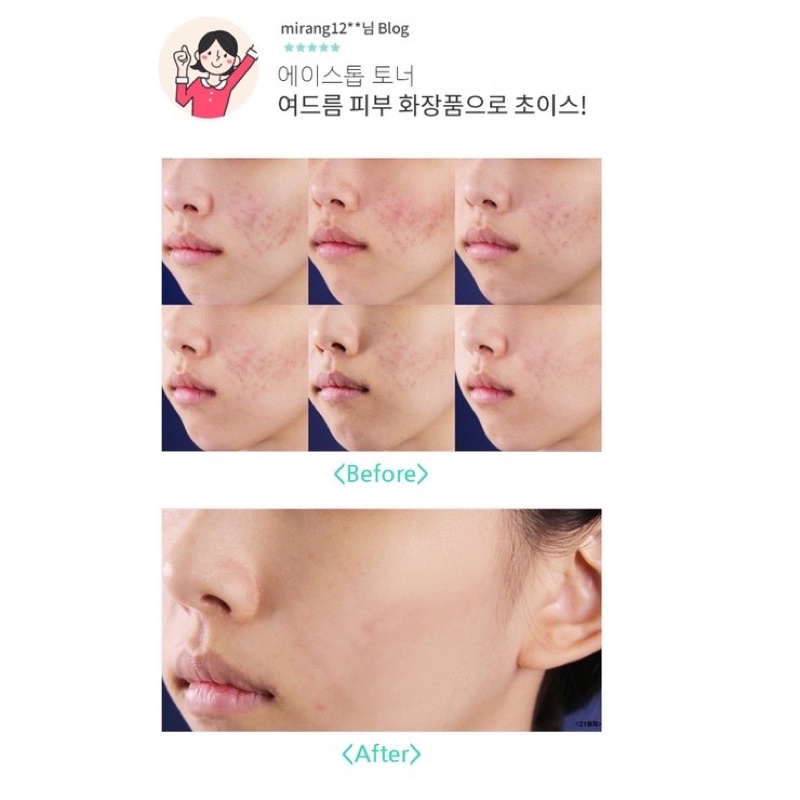Huyết thanh thay đổi làn da mụn trong 5 ngày A.Stop Clear Serum