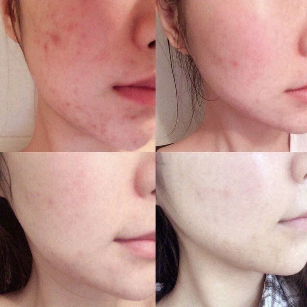 Sữa rửa mặt tràm trà Naruko Tea Tree Purifying Clay Mask & Cleanser 120g cho da dầu mụn