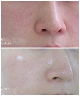 Serum The Ordinary zinc 1%