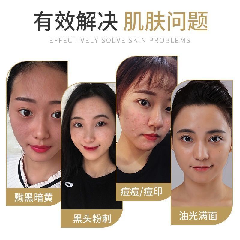 Kem Hỗ Trợ Giảm Mụn Trứng Cá Làm Mờ Vết Thâm Mụn Phục Hồi Miệng Trẻ Hóa Làn Da Cho Học Sinh Manshanzc.My11.27 | BigBuy360 - bigbuy360.vn