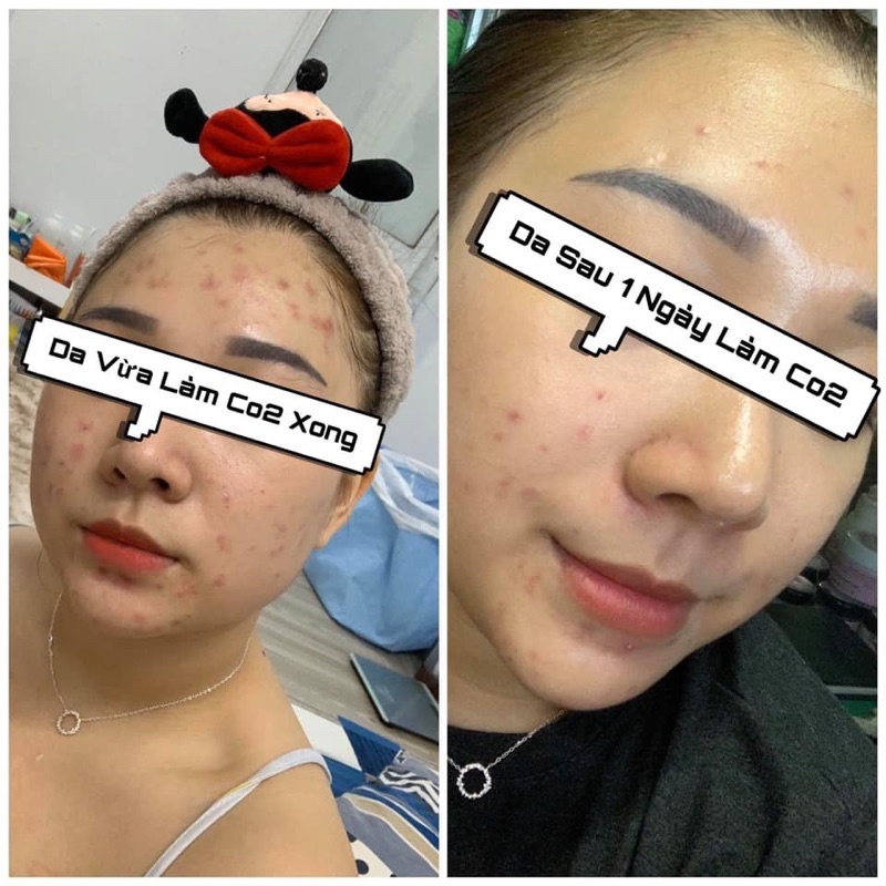 Bộ thải độc sạch sâu căng bóng CO2 Carboxy Sound Ribeskin giúp da trẻ hóa và ngừa mụn