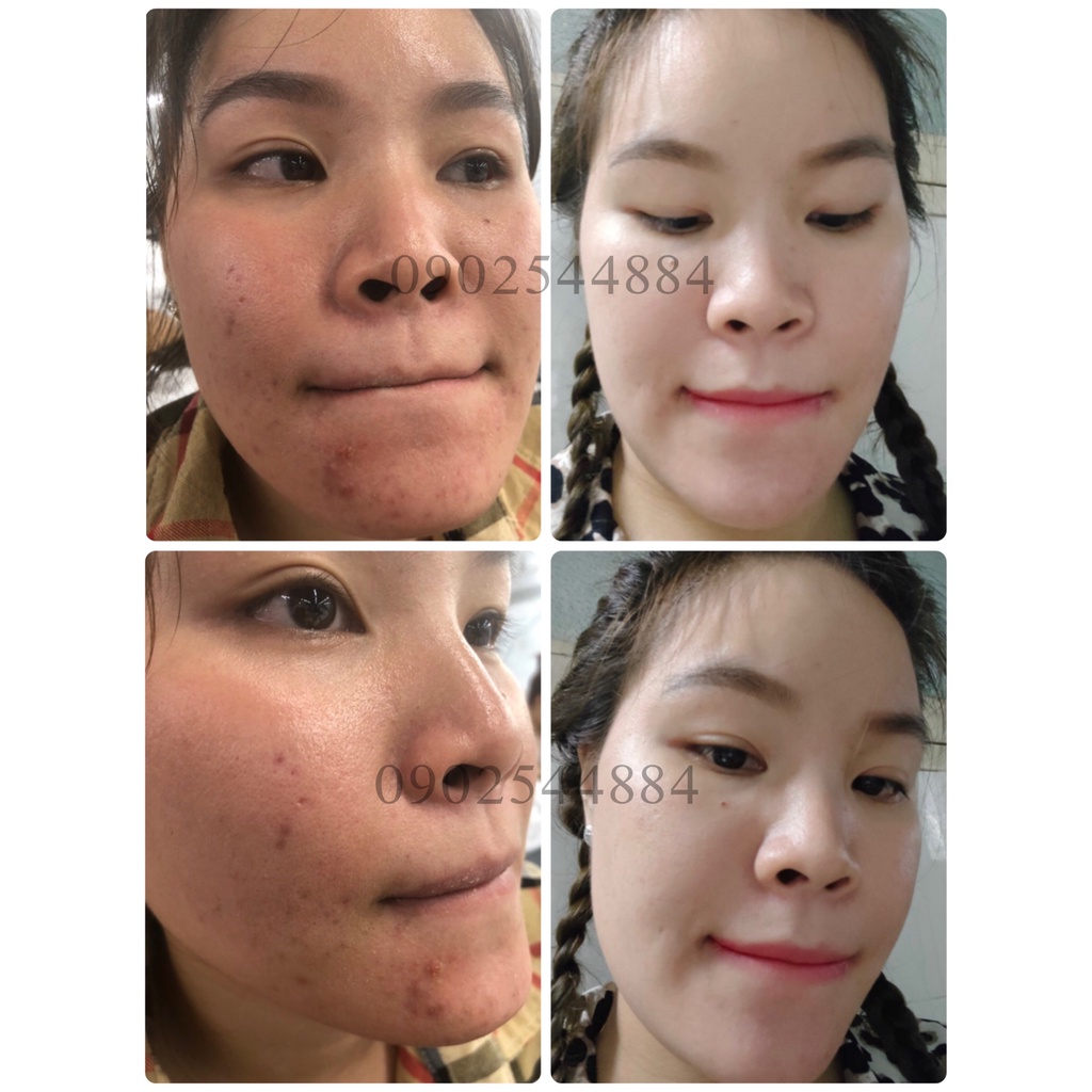 Serum mụn Hoàng Trinh