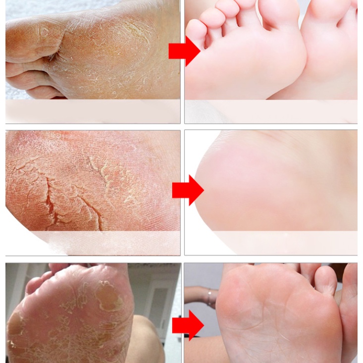 Mặt nạ bàn chân tẩy da chết với chiết xuất hoa oải hương dưỡng ẩm và làm trắng da