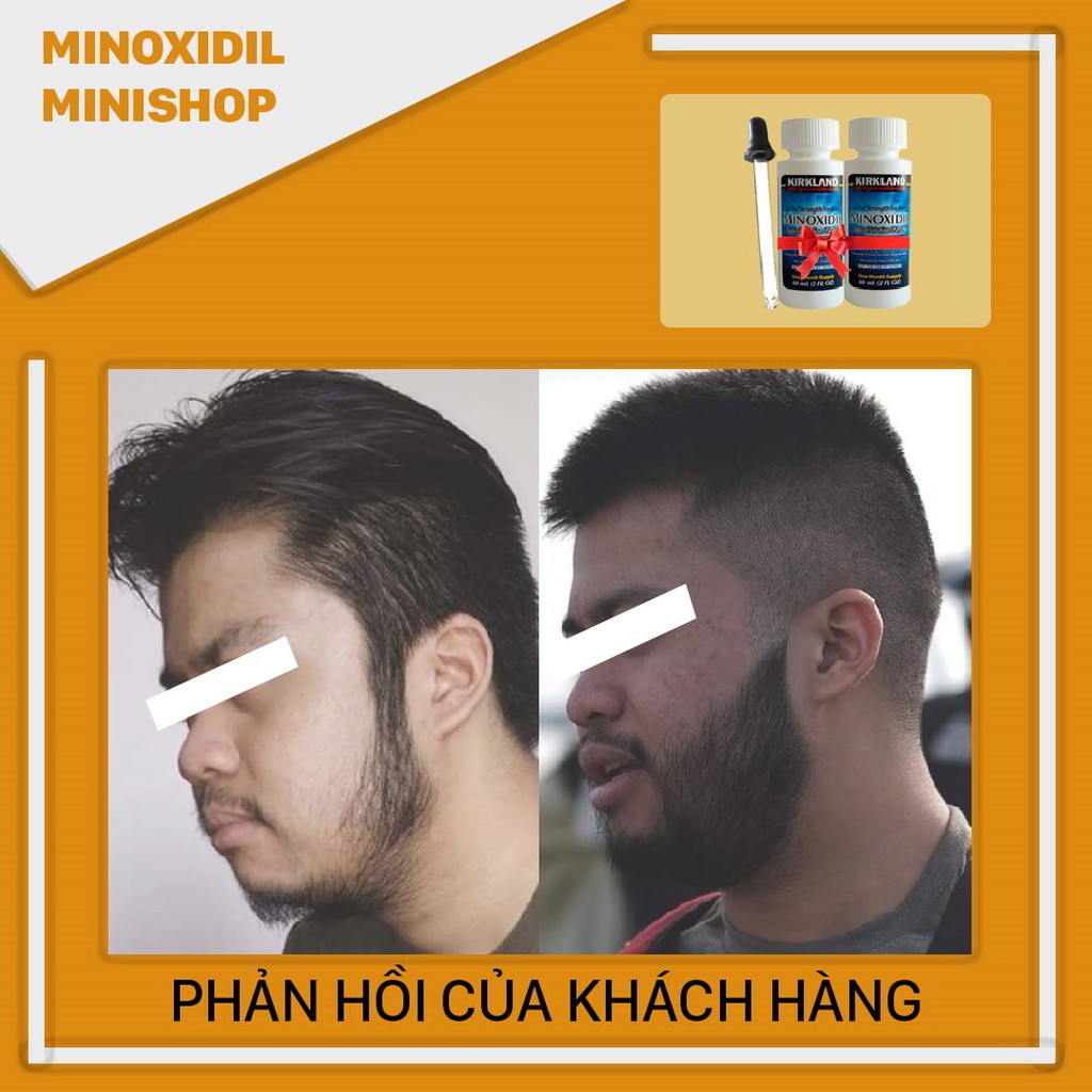 Minoxidil 5% Dạng Lỏng Mọc Râu Tóc Kirkland Mỹ Combo 2 Lọ