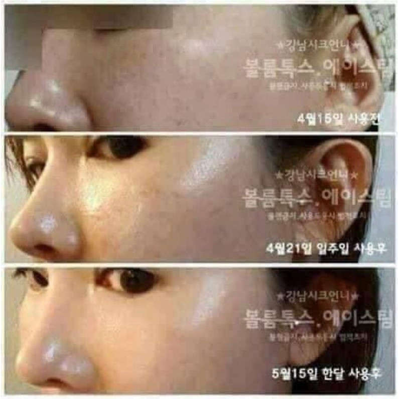 Serum hạn Chế nám Dong sung Hàn Quốc