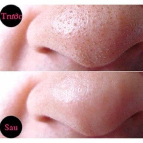 Gel Lột Mụn Than Tre Hoạt Tính Sạch Mụn Cám 50g