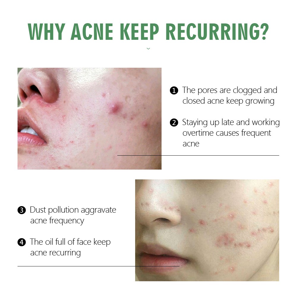 Serum Hỗ trợ giảm Vết Sẹo Loại Bỏ Mụn Làm Trắng Da Tinh Chất Tràm Trà 30ml Vibrant Glamor | BigBuy360 - bigbuy360.vn