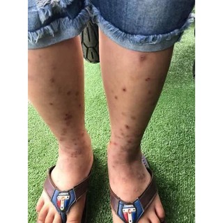 SERUM MỜ THÂM ĐA NĂNG PHÚC MINH TÂM [Chuẩn Hàng công ty]