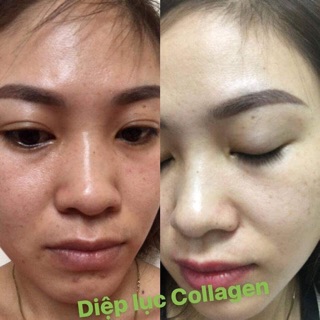 Diệp lục collagen