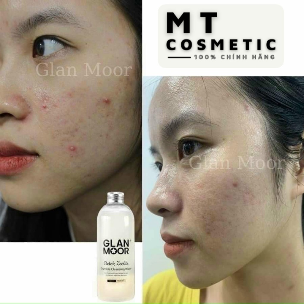 Nước Tẩy Trang Thải Độc Tố GLAN MOOR Chính Hãng HQ Detok Zeolite Trumble Cleasing Water - 300ml - Giảm Và Ngăn Ngừa Mụn