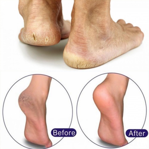 Kem Dưỡng Fixderma Foot Cream Mềm Mịn, Chống Nứt Nẻ Gót Chân 60g