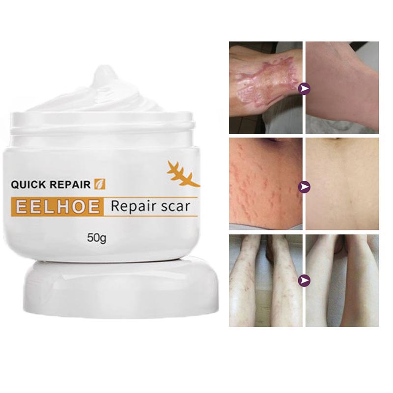 EELHOE kem xóa sẹo