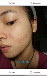 Kem lành thâm sẹo mụn Smoothe