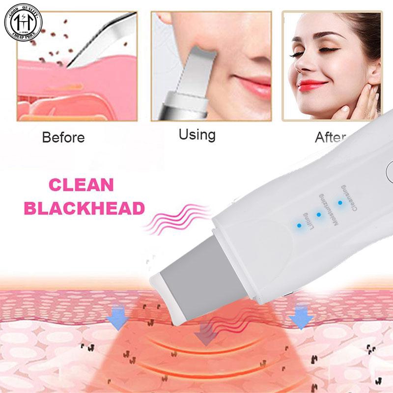 Dụng cụ nặn mụn đầu đen hiệu quả