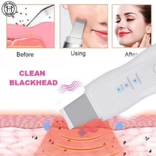 Dụng cụ nặn mụn đầu đen hiệu quả