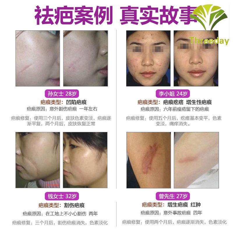 3D❤ Scar Removal Cream Lavender Cream Skin Care Natural Remove Burn Stretch Marks Ointment