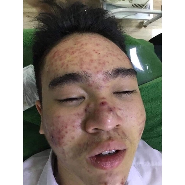 Thảo mộc thiên nhiên Hỗ Trợ Giảm Mụn | BigBuy360 - bigbuy360.vn