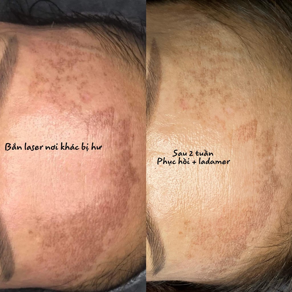 Bộ kem dưỡng trắng da giảm nám Ladamer Intensive Whitening Cream