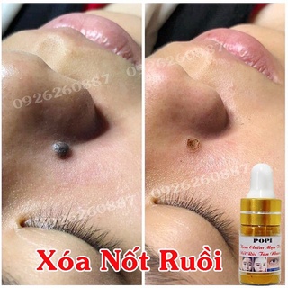 Tẩy nốt ruồi,tàn nhanh,mụn thịt,mụt cóc popi