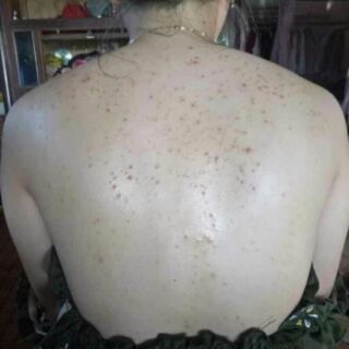 Mụn lưng, viêm lỗ chân lông
