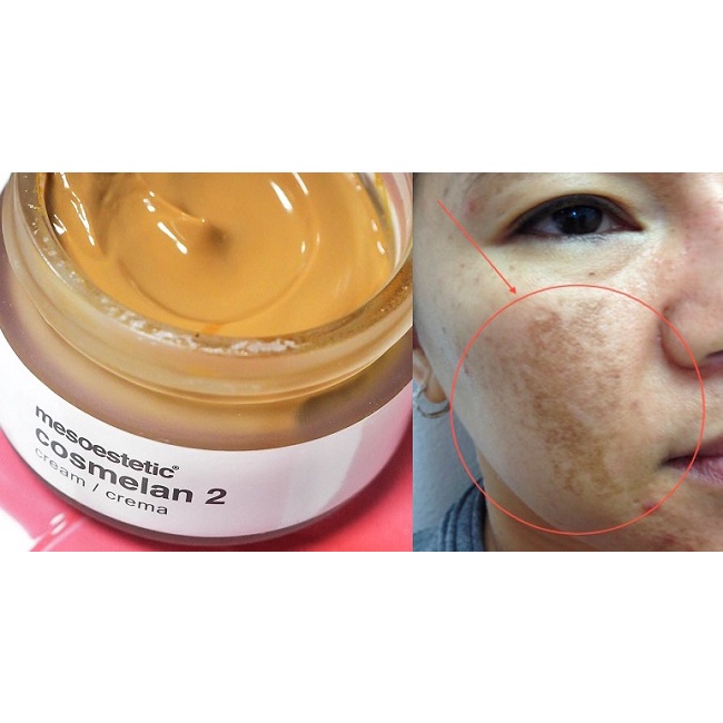 Kem giúp giảm nám Mesoestetic Cosmelan 2