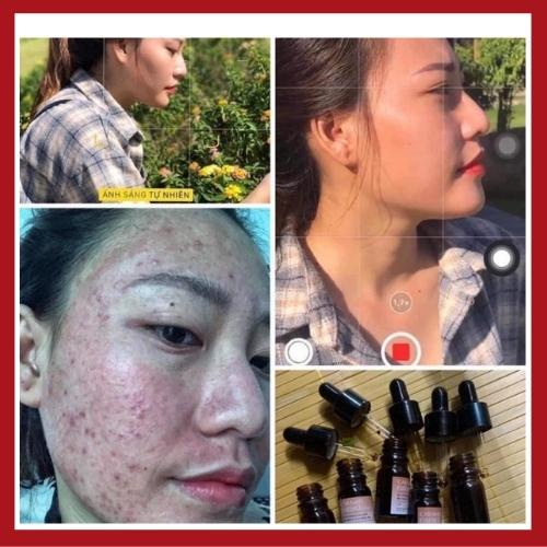 Serum Giảm Mụn CARAMEL ESSENCE Nhật Bản Giảm Ngừa Mụn Xóa Thâm Mờ Sẹo Tái Tạo Dưỡng Da Căng Bóng 5ml