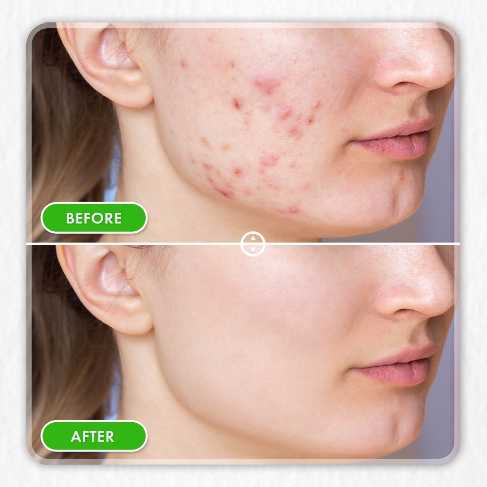 Kem Ngừa Mụn, Mờ Thâm, Liền Sẹo Chiết xuất tảo nâu từ Pháp - Ori'be Anti Acne Cream - Tuýp 20g