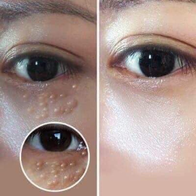 Kem mụn thịt Tsubuporon Eye Essence  Nhật Bản - Guu