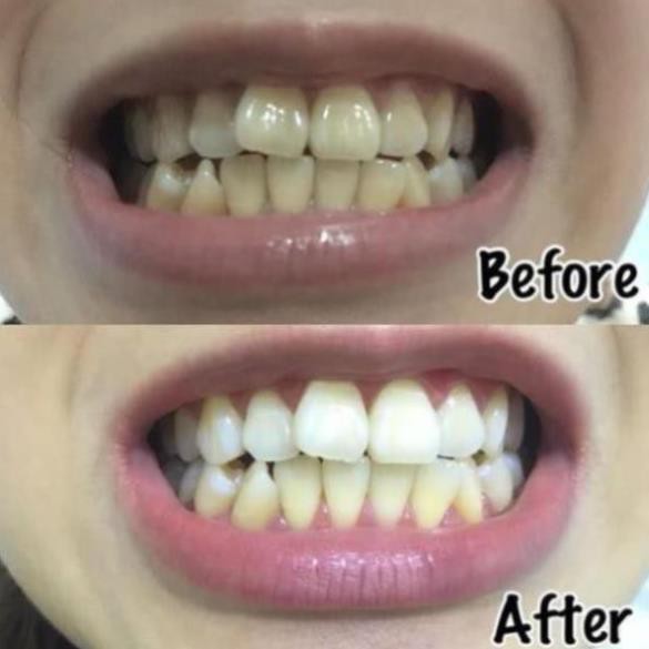 Combo 14 miếng (7 gói/7 ngày) dán trắng răng Crest 3D White Whitestrips loại Professional Effects - Mỹ