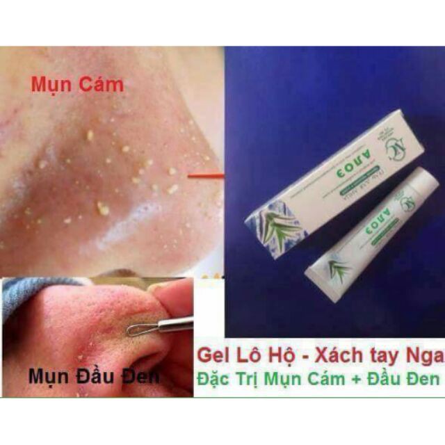 Gel lô hội giảm sạch mụn bọc, mụn cám, hết viêm cam kết  khỏi trong 1 liệu trình [hàng chuẩn Nga cao cấp]