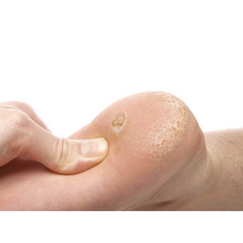 Miếng dán trị mục cóc, mụn cơm, vết chai | BigBuy360 - bigbuy360.vn