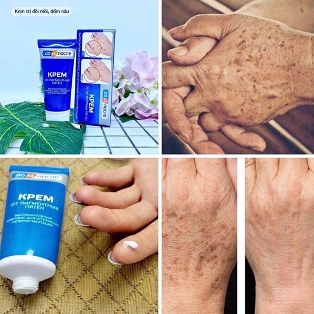 Kem bôi mờ đồi mồi Kpem Nga