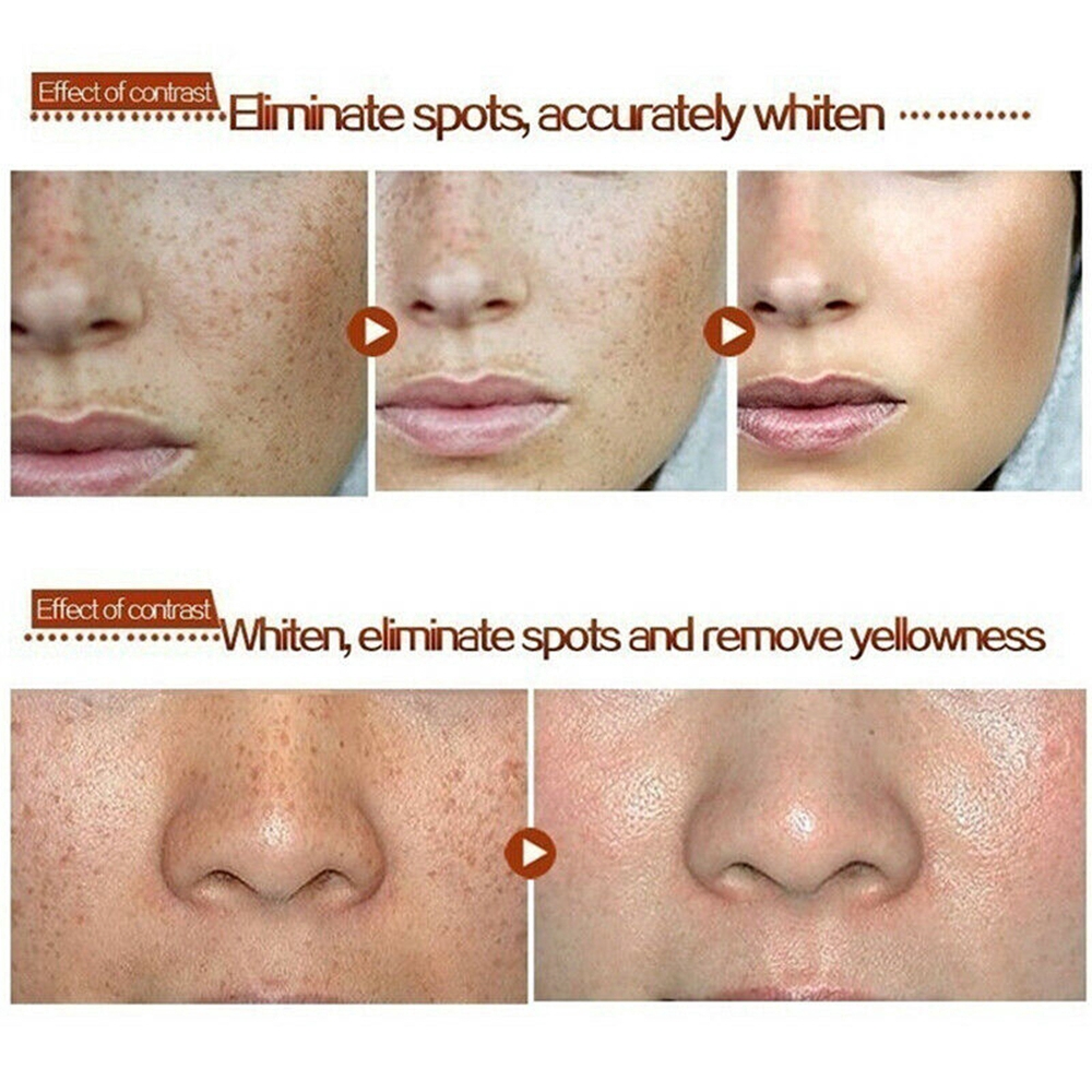 [Hàng mới về] Kem xóa tàn nhang 30g làm trắng phục hồi và chăm sóc da hiệu quả