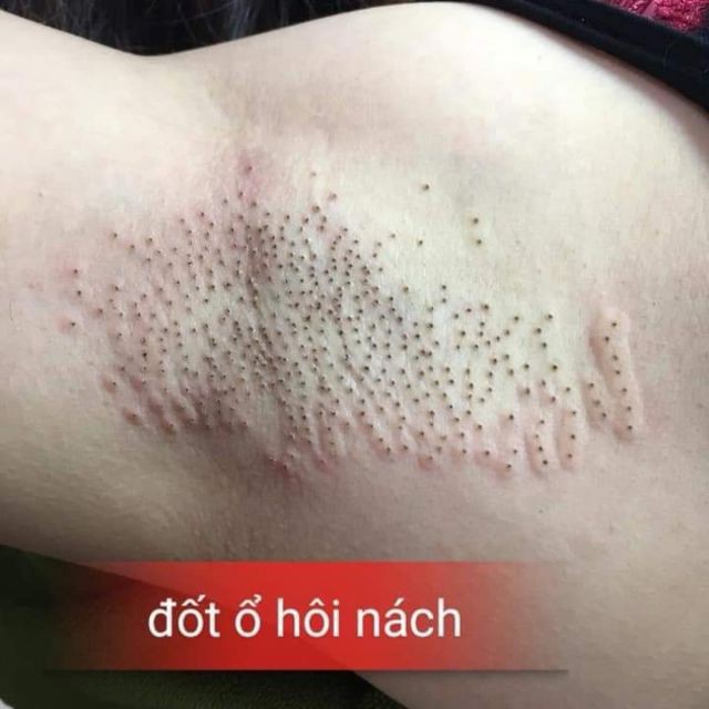 XỊT NGĂN MỒ HÔI TAY CHÂN MỒ HÔI NÁCH NỘI ĐỊA 20ML mẫu mới - hàng có sẵn