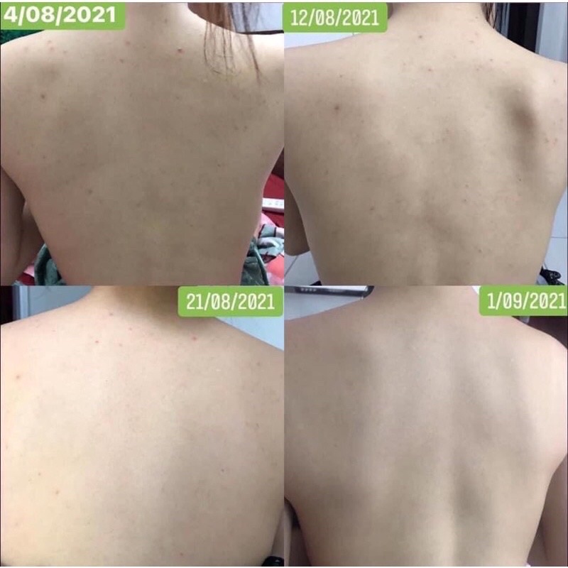 Xịt thảo mộc viêm nang lông(50ml)