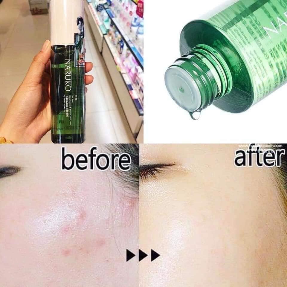 Toner Kiềm Dầu Mụn Naruko Tea Tree Shine Control and Blemish Clear Toner 150 ml