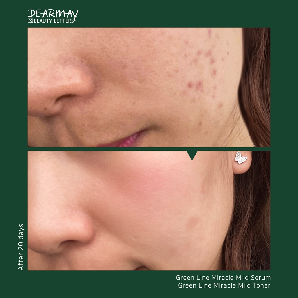 Tinh Chất Dưỡng Dearmay Green Line Miracle Mild Serum 15ml